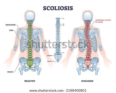 Scoliosis as medical sideways curvature illness of spine outline diagram. Labeled educational scheme with healthy and abdominal backbone skeleton comparison vector illustration. Deformity posture. Foto d'archivio © 