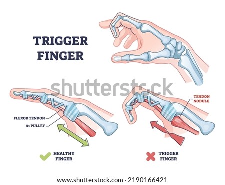 Trigger finger as finger stuck in bent position condition outline diagram. Labeled educational scheme with medical trauma with bending index finger, flexor tendon or pulley anatomy vector