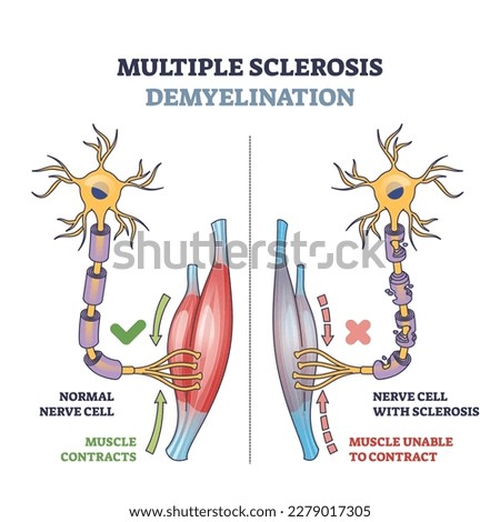 Multiple sclerosis demyelination compared with medical healthy nerves outline diagram. Labeled educational scheme with anatomical and medical autoimmune disease muscle contraction vector illustration