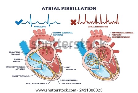 Atrial fibrillation as abnormal heart beat frequency disease outline diagram. Labeled educational scheme with cardiovascular condition and heart structure vector illustration. Anatomical explanation.