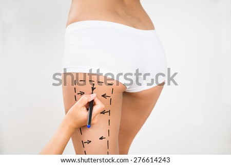 Person Hand Drawing Lines On A Woman\'s Thigh As Marks For Thigh Cellulite Correction