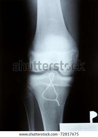 X-ray of broken knee