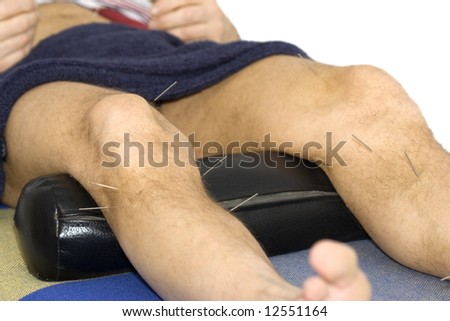 acupuncture treatment - man lying on back receiving acupuncture