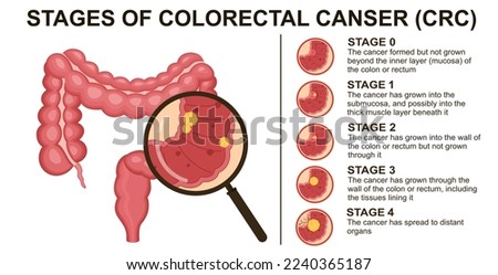 Stages of colorectal cancer CRC. Colon cancer. Colorectal oncology tumor. Bowel cancer.	

