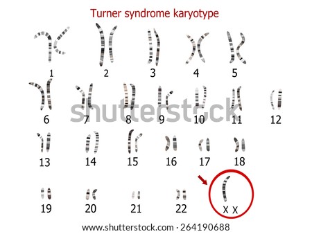 Turner Syndrome Karyotype Stock Photo 264190688 : Shutterstock