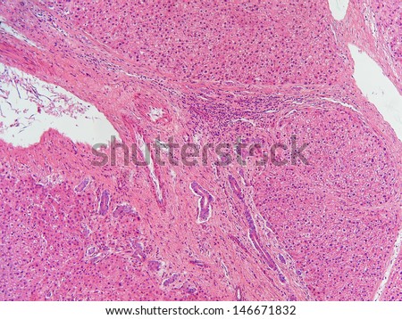 Human liver cirrhosis showing fibrosis running through the center of the photo.  Magnification: 100x