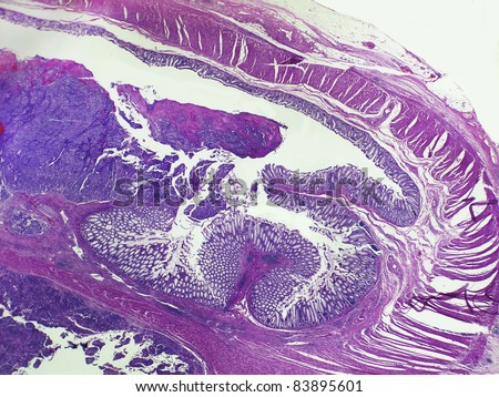 A low power image of gall bladder carcinoma.  Crypts are easily seen.  Other blue areas are regions of  malignant tissue.