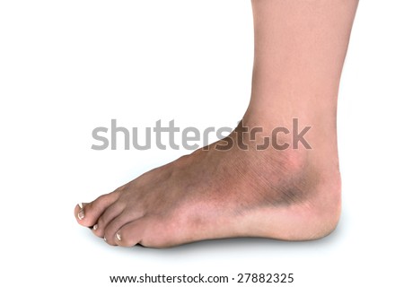 Woman With Swollen Broken Foot Covered With Bruises On White Background ...