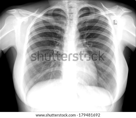 X-ray image chest