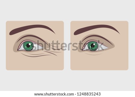 Removal of wrinkles under eyes, blephoroplasty of lower eyelids, rejuvenation of skin under eyes, filling facial wrinkles. Vector illustration before and after