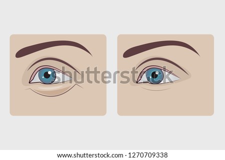 Bags under eyes of woman, plastic surgery to remove hernia under eyes of girl, swollen lower eyelid. Vector illustration
