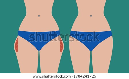 Hip liposuction, hip correction before and after. Exercises for local fat removal. Vector illustration