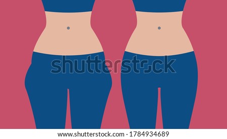 Hip liposuction, hip correction before and after. Exercises for local fat removal. Vector illustration