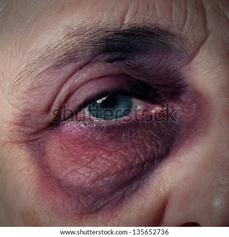Senior abuse or elder mistreatment as an old person with a black eye bruised and injured from domestic violence from a retirement home or caretaker as broken trust legal health care concept.
