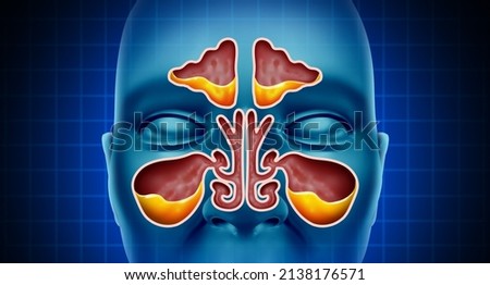 Sinus Infection and Sinusitis illness as a nasal cavity blockage disease with a congested nose full of mucus or pus in a 3D illustration style. Imagine de stoc © 