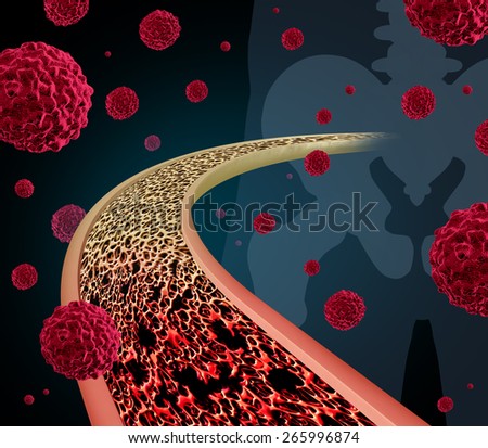 Bone cancer concept illustration as a close up diagram of the inside of a human anatomy from a skeletal hip joint as a normal healthy medical condition being afflicted with malignant tumor cells.