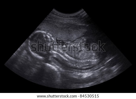Ultrasound diagnosis of pregnant women