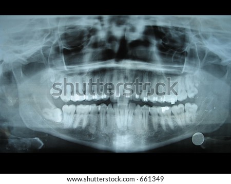 Panoramic dental radiology slide from my jaw.  This slide helps dentists know the position of teeth and molars.