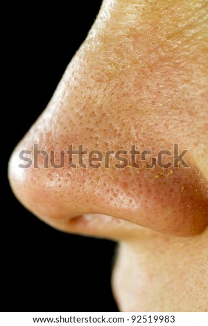 Women\'s Fatty Nose Pores