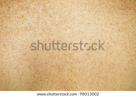 Caucasian Female Back Skin Showing Assortment Of Freckles. Stock Photo ...