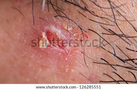 exploded pimple macro over a white man skin with stubble