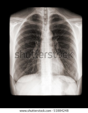 Human Chest With Normal Lungs On X-Ray Stock Photo 51884248 : Shutterstock