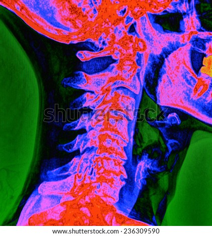 A digital, color enhanced x-ray of a human spine curvature