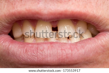 men crooked teeth. macro