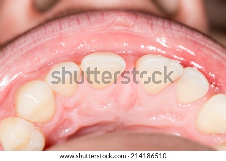 teeth in the mouth. close-up