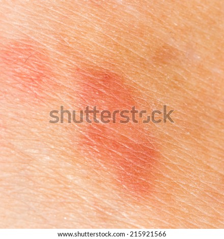 mosquito bites on the skin. close-up