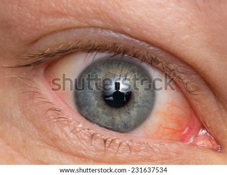 Chronic Conjunctivitis Eye With A Red Iris And Pus Close-Up. Stock ...