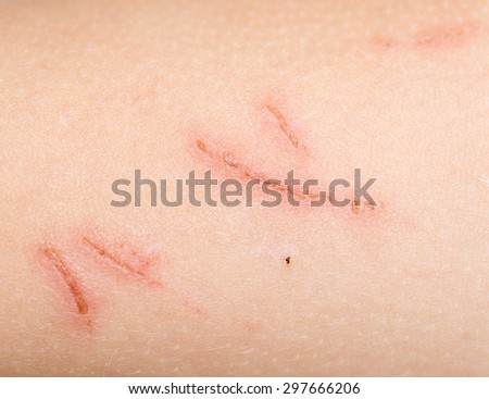 A Wound On The Skin. Close Stock Photo 297666206 : Shutterstock