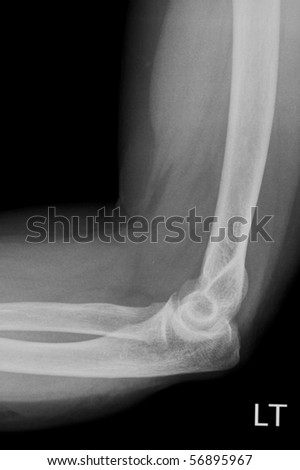 X-Ray Of Elbow In The Lateral Position Stock Photo 56895967 : Shutterstock