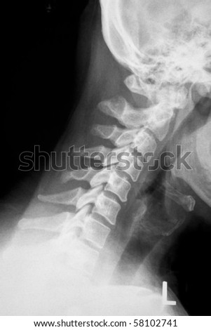 Lateral Xray Of Neck And Cervical Spine Stock Photo 58102741 : Shutterstock