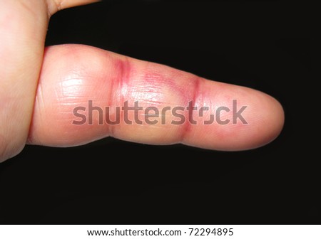 finger injury, swollen, bruised and inflamed after a joint dislocation