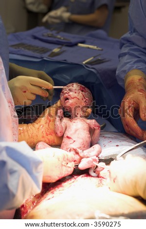 The birth of a child (via cesarean section operation) and being removed and cleaned by surgeons. In this particular image this child is premature.