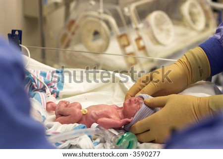 A premature newborn just after a c-section is cleaned up and prepped for the incubator shown in the background.