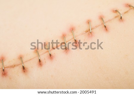 Metal staples (satures) in a scar left from a Laparotomy/laparoscopy â€“ Close-up, Shallow Depth of field