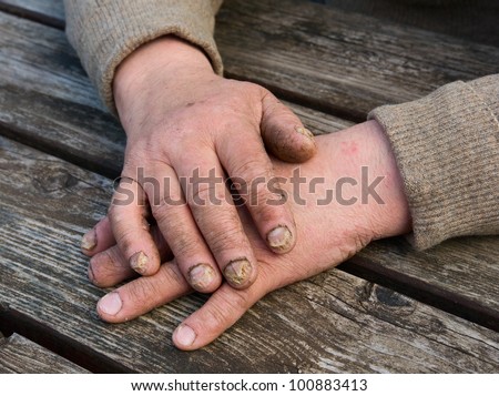 Fungus Infection on Nails Hand elderly man
