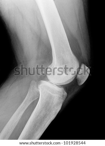 X-Ray Of The Knee Elderly Man, Front View Stock Photo 101928544 ...