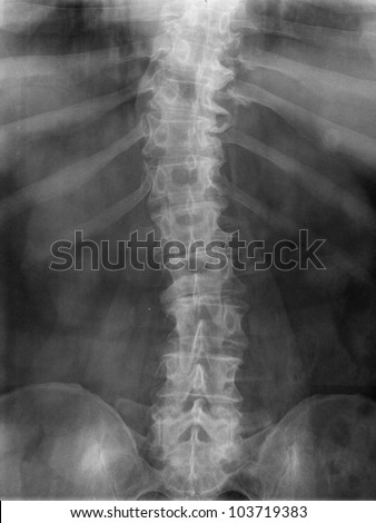 X-Ray Image Of The Spine Bones Elderly Person Stock Photo 103719383 ...