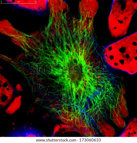 Tumor cells under microscope labeled with fluorescent molecules