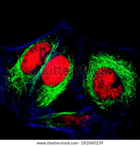 Epithelial tumor cells labeled with fluorescent molecules