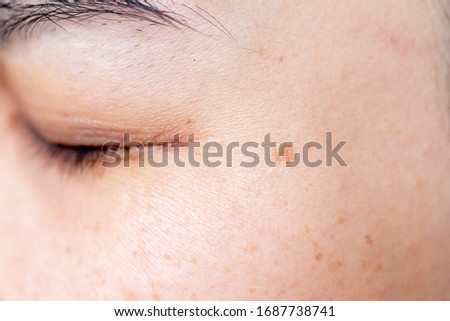 Freckles Over Asian Woman Face, Skin Problems
 ストックフォト © 