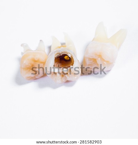 highly decayed wisdom tooth isolated on a white background.