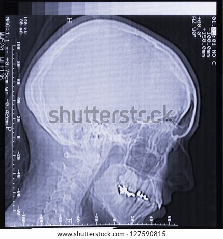magnetic resonance (MR) scan of brain, skull, head, neck and face