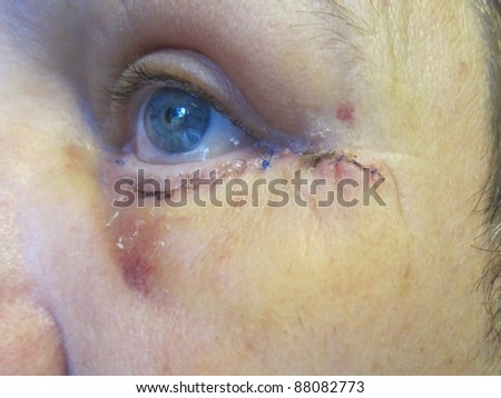 post operation eyelid lift in detail view