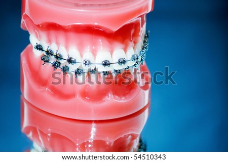 Dentures with braces on blue background