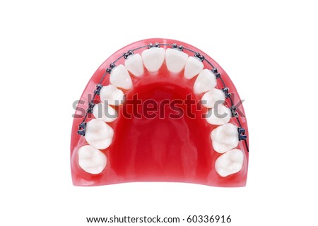 Denture with braces , upper jaw , isolated on white