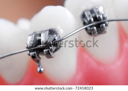 Dental braces super macro ,  crooked teeth
